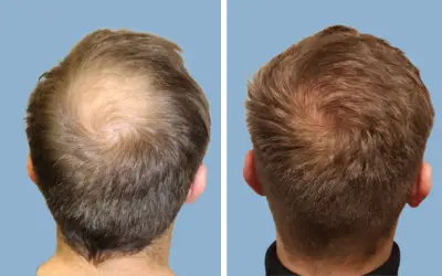Before and After